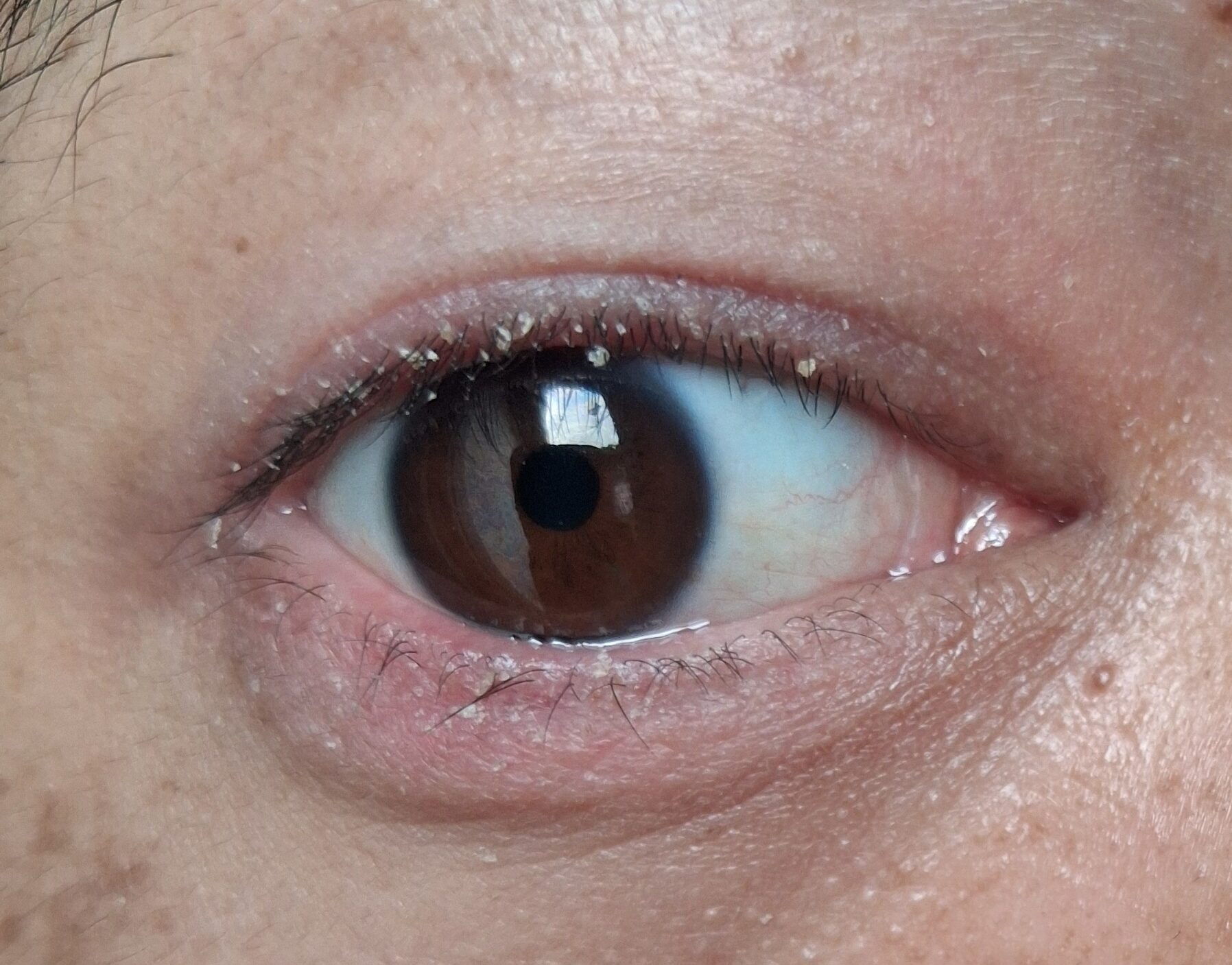 Eyelid Crusting and Flakes