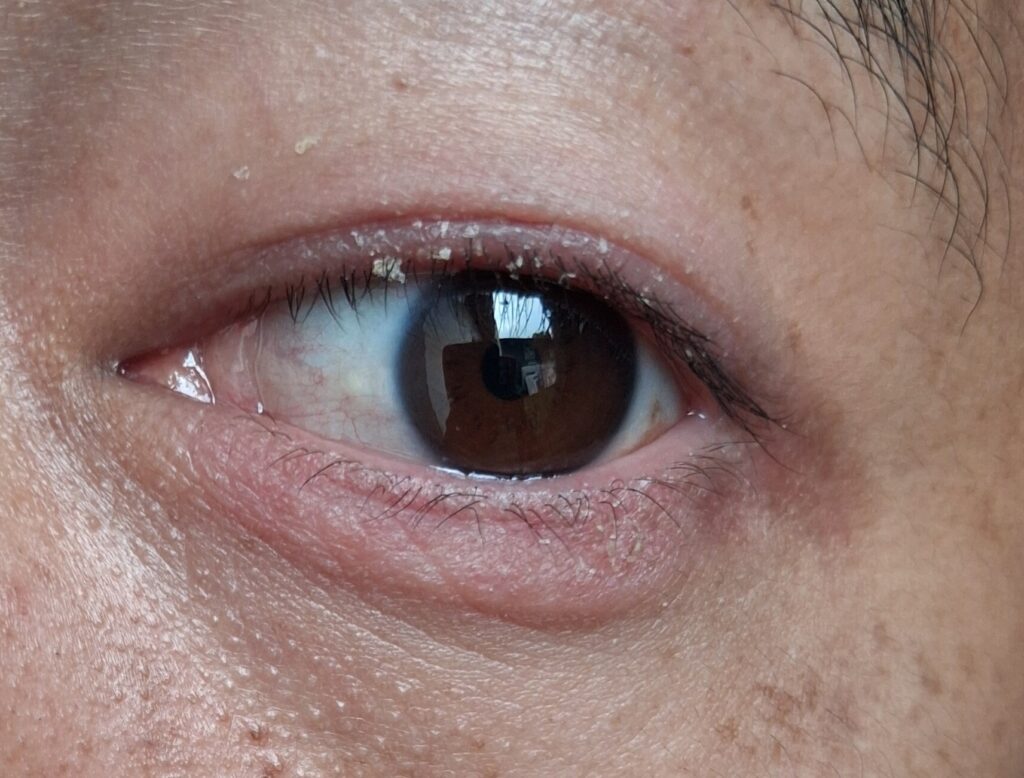 Close-up of a human eye with eyelid crusting and flakes on the eyelashes, showing symptoms of blepharitis and eyelid inflammation and it forms like dandruff.